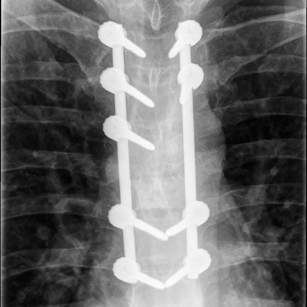 Polytrauma - Serie von Bleistiftzeichnungen in Skizzenbuch - Röntgenbild von postoperativen Brustwirbelbrüchen